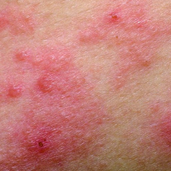 dermatitis