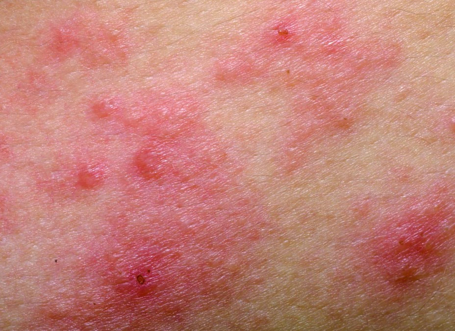 dermatitis