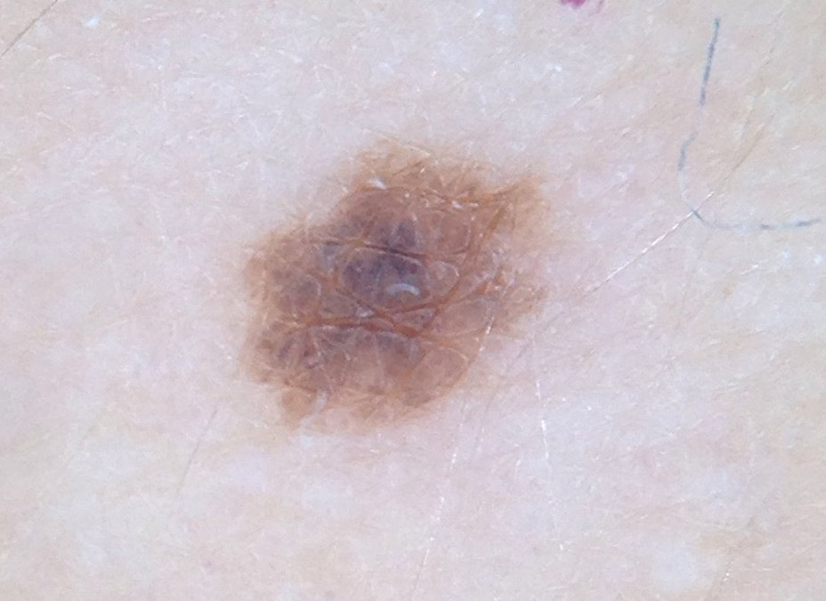 nevus