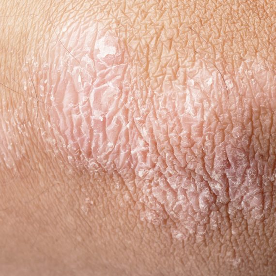 psoriasis