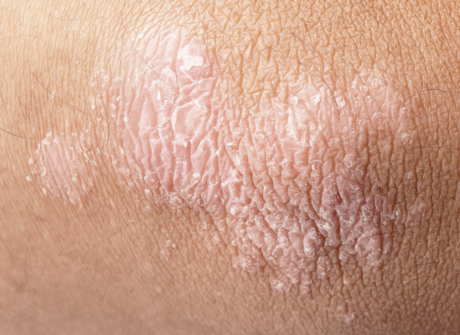 psoriasis