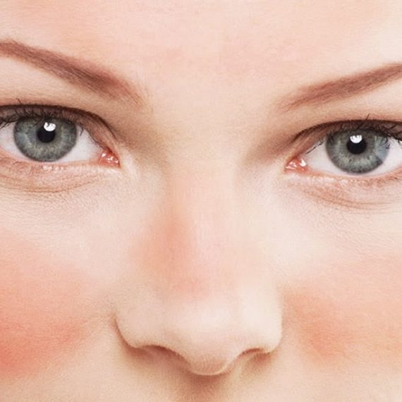 rosacea