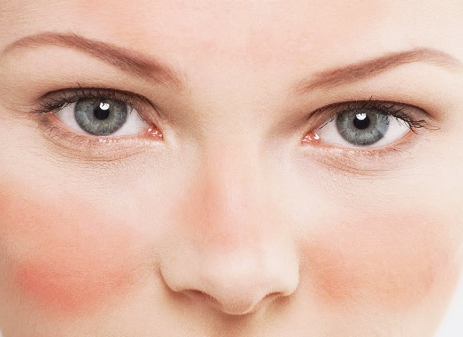 rosacea